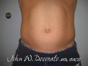 SculpSure Before and After Pictures in Staten Island, NY