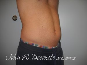 SculpSure Before and After Pictures in Staten Island, NY