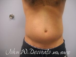 SculpSure Before and After Pictures in Staten Island, NY