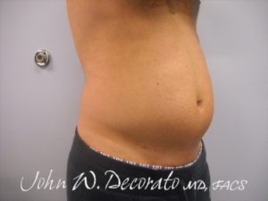 SculpSure Before and After Pictures in Staten Island, NY