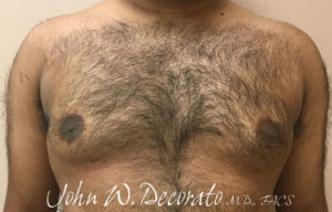 Gynecomastia Before and After Pictures Staten Island, NY