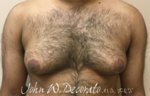 Gynecomastia Before and After Pictures Staten Island, NY