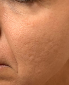 Laser Treatments Before and After Photos in Staten Island, NY