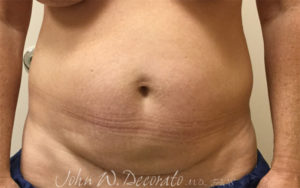 Tummy Tuck Before and After Pictures in Staten Island, NY