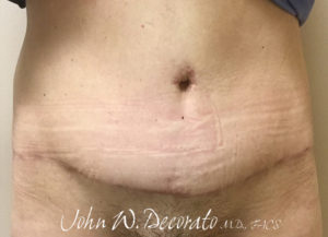 Body Lift Before and After Photos in Staten Island, NY