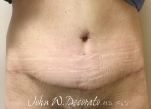Body Lift Before and After Photos in Staten Island, NY