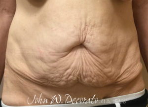 Body Lift Before and After Pictures in Staten Island, NY