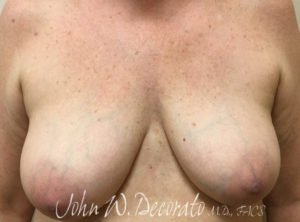 Breast Reduction Before and After Pictures Staten Island, NY