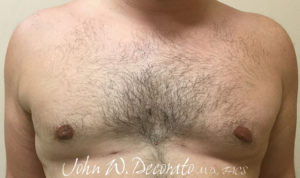 Gynecomastia Before and After Pictures Staten Island, NY