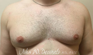 Gynecomastia Before and After Pictures Staten Island, NY