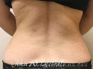 Liposuction Before and After Pictures in Staten Island, NY