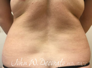 Liposuction Before and After Pictures in Staten Island, NY