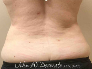 Liposuction Before and After Pictures in Staten Island, NY