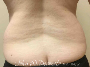 Liposuction Before and After Pictures in Staten Island, NY