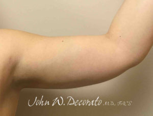 Liposuction Before and After Pictures in Staten Island, NY