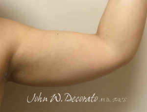 Liposuction Before and After Pictures in Staten Island, NY