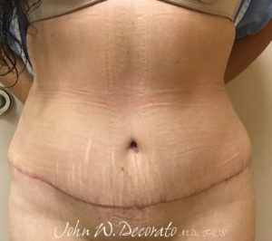 Tummy Tuck Before and After Pictures in Staten Island, NY