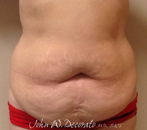 Tummy Tuck Before and After Pictures in Staten Island, NY