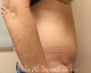 Tummy Tuck Before and After Pictures in Staten Island, NY