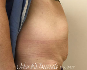 Tummy Tuck Before and After Pictures in Staten Island, NY
