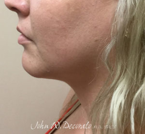 Liposuction Before and After Pictures in Staten Island, NY