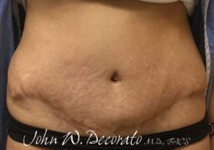 Tummy Tuck Before and After Pictures in Staten Island, NY