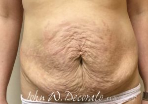 Tummy Tuck Before and After Pictures in Staten Island, NY