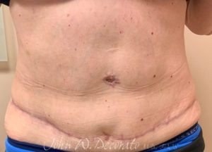 Tummy Tuck Before and After Pictures in Staten Island, NY