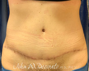 Tummy Tuck Before and After Pictures in Staten Island, NY