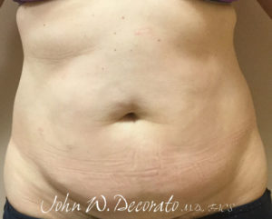 Tummy Tuck Before and After Pictures in Staten Island, NY