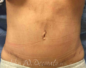 Tummy Tuck Before and After Pictures in Staten Island, NY