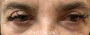 Blepharoplasty (Eye Lid Surgery) Before and after Pictures in Staten Island, NY