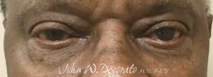 Blepharoplasty (Eye Lid Surgery) Before and after Pictures in Staten Island, NY