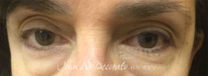 Blepharoplasty (Eye Lid Surgery) Before and after Pictures in Staten Island, NY