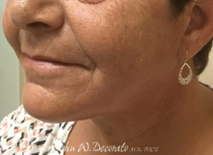 Neck Lift Before and After Pictures in Staten Island, NY