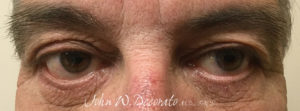 Blepharoplasty (Eye Lid Surgery) Before and after Pictures in Staten Island, NY