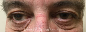 Blepharoplasty (Eye Lid Surgery) Before and after Pictures in Staten Island, NY