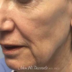Thread Lift Before and After Pictures in Staten Island, NY