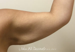 Arm Lift Before and After Photos in Staten Island, NY