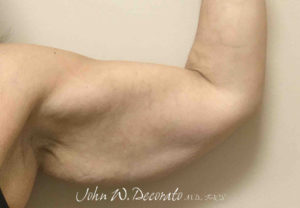 Arm Lift Before and After Photos in Staten Island, NY