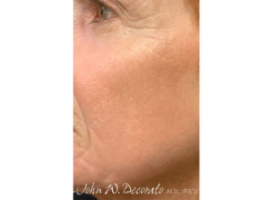 Laser Treatments Before and After Pictures in Staten Island, NY