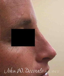 Rhinoplasty Before and After Pictures in Staten Island, NY