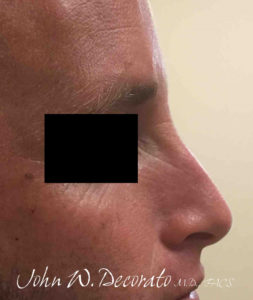 Rhinoplasty Before and After Pictures in Staten Island, NY