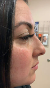 Liquid Rhinoplasty Before and After Pictures in Staten Island, NY