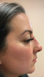 Liquid Rhinoplasty Before and After Pictures in Staten Island, NY